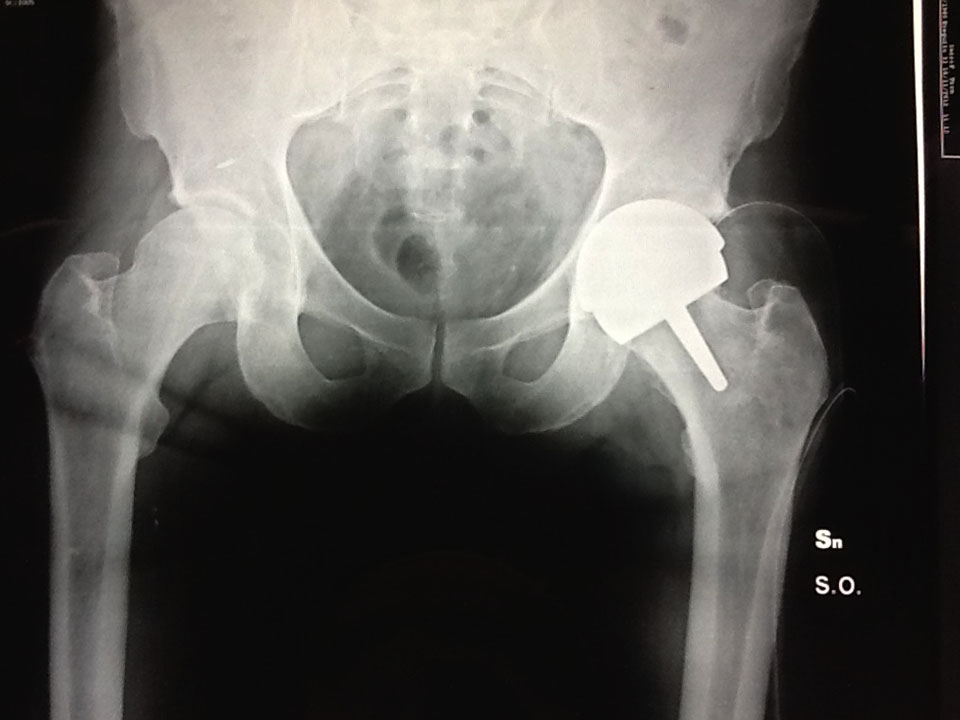 allegato protesi anca