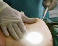laser liposilisimod vig
