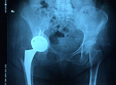 rx post-operatoria art