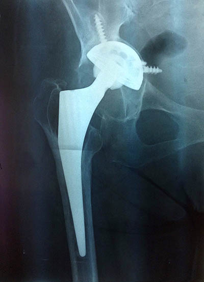 rx pre-operatoria art