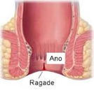 ragade-anale-2