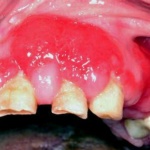 Fig. 9: Iperplasia gengivale da calcioantagonisti