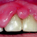 Fig. 10: Iperplasia gengivale da calcioantagonisti