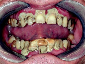 Fig. 3: Gengivite da presenza massiccia di tartaro con compromissione parodontale