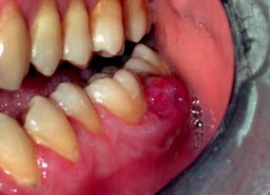 Fig. 4: Gengivite edematosa con formazione di Tumor gravidicus zona 36-37 in paziente gravida al 6° mese