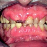 Fig. 8: Iperplasia gengivale da ciclosporina in soggetto con trapianto renale