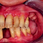 Fig. 6: Iperplasia gengivale aziente affetto da epilessia in ciclosporina in soggetto con terapia con difenilidantoina