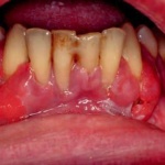 Fig. 7: Iperplasia gengivale da ciclosporina in paziente affetta da lichen planus erosivo recalcitrante alla terapia cortisonica