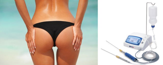 Vibro-liposuzione, la nuova era della liposuzione
