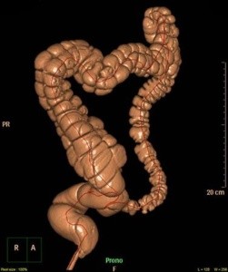 Diverticolosi e diverticolite del colon cause, evoluzione e terapie