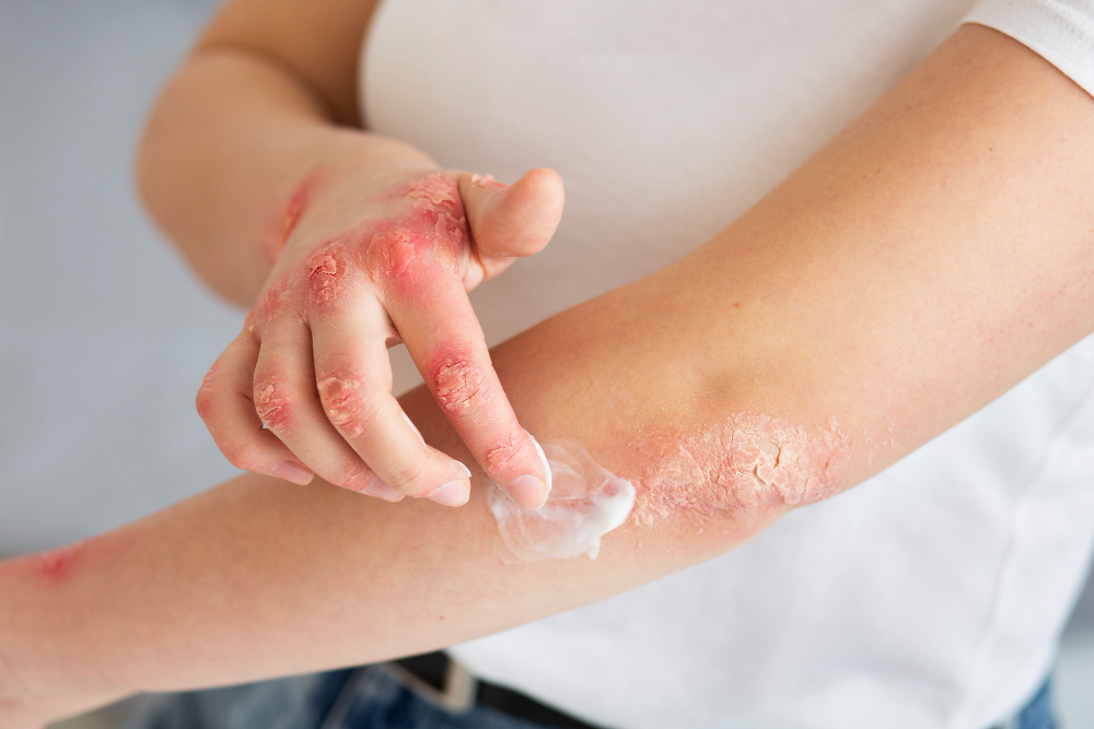 Psoriasi: si può davvero curare o solo controllare i sintomi?