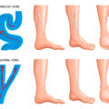 schiuma sclerosante