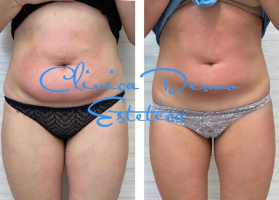 Accent prime un trattamento innovativo in grado di rendere più armonioso il nostro corpo