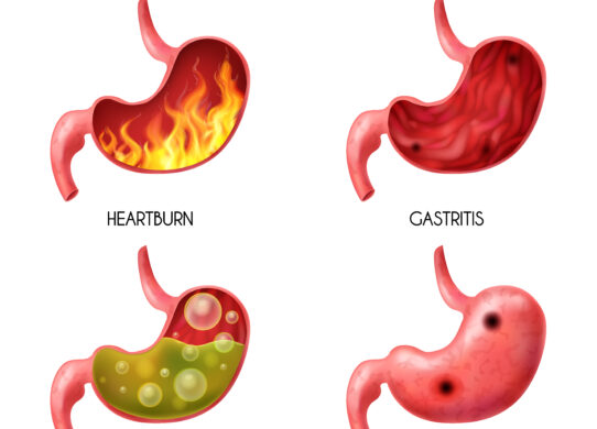 Acidità di Stomaco