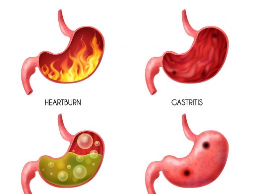 Acidità di stomaco cause e prevenzione (2)