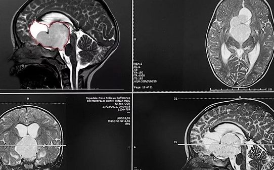 Bambina di 18 mesi operata per tumore raro al cervello