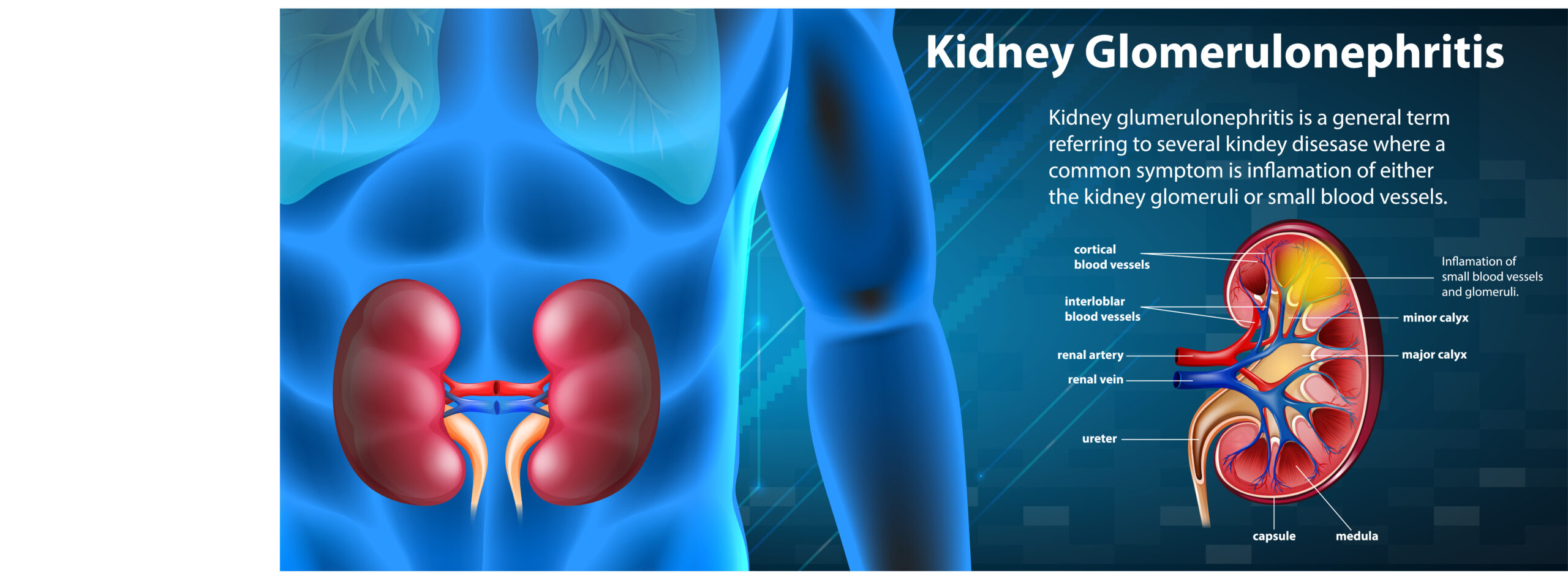Calcoli renali: cause e rimedi
