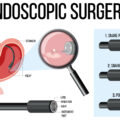 Calo di peso con tecniche endoscopiche Mininvasività e sicurezza per il paziente