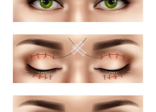 Cos'è la blefaroplastica