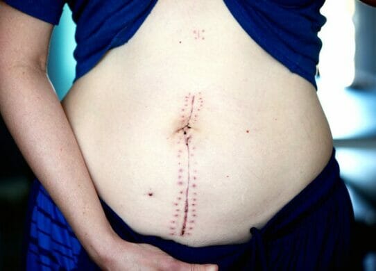 Cicatrici prevenzione e trattamento con la fisioterapia