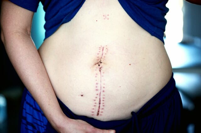 Cicatrici: prevenzione e trattamento con la fisioterapia