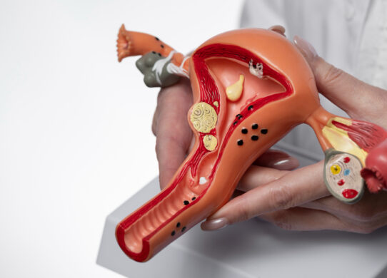 Cisti ovariche un comune problema