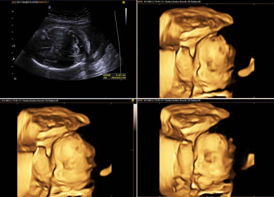 Controlli in gravidanza l’ecografia 3D-4D