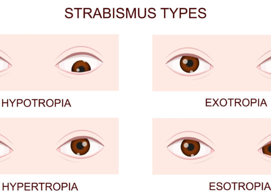 Cosa è lo strabismo