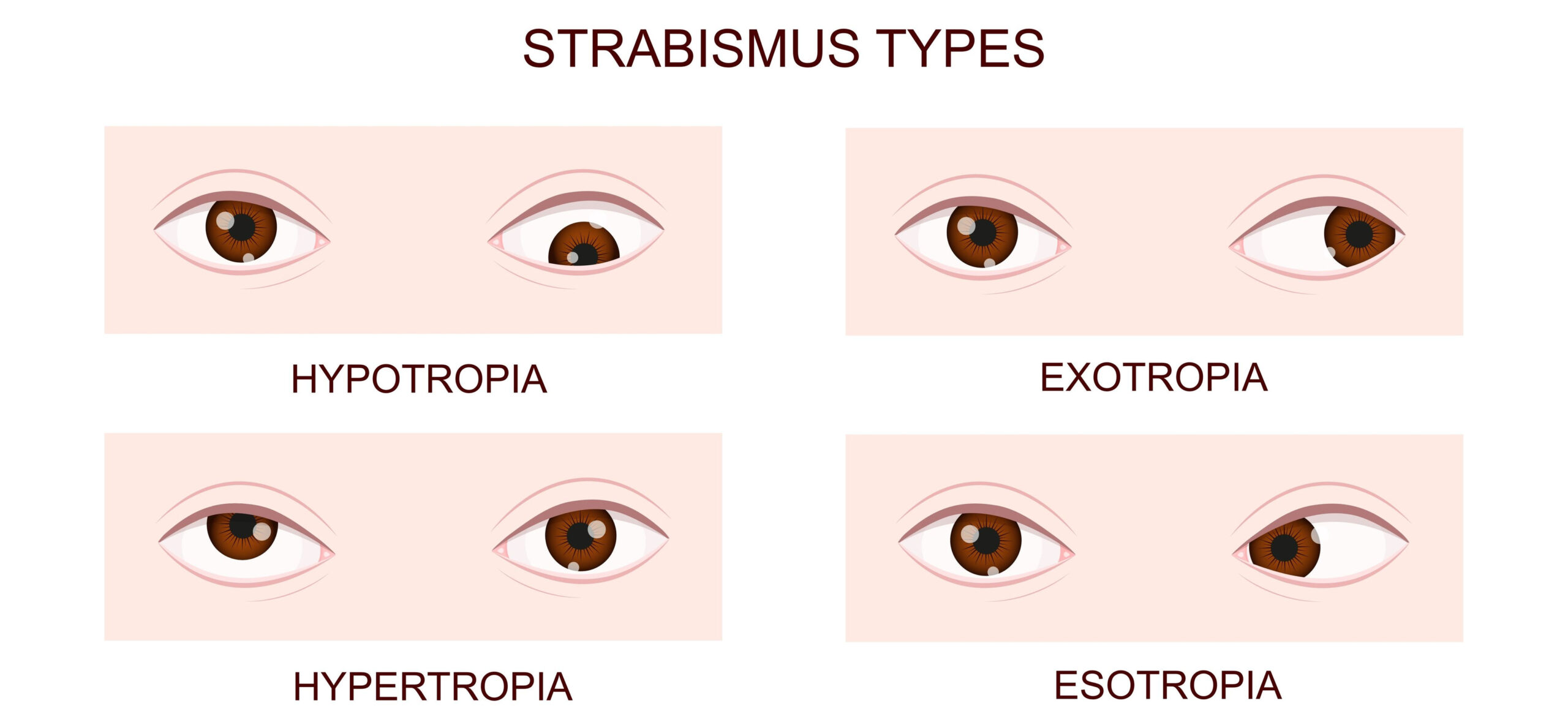 Strabismo: tipologie e sintomi