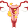 Cosa sono i fibromi uterini?