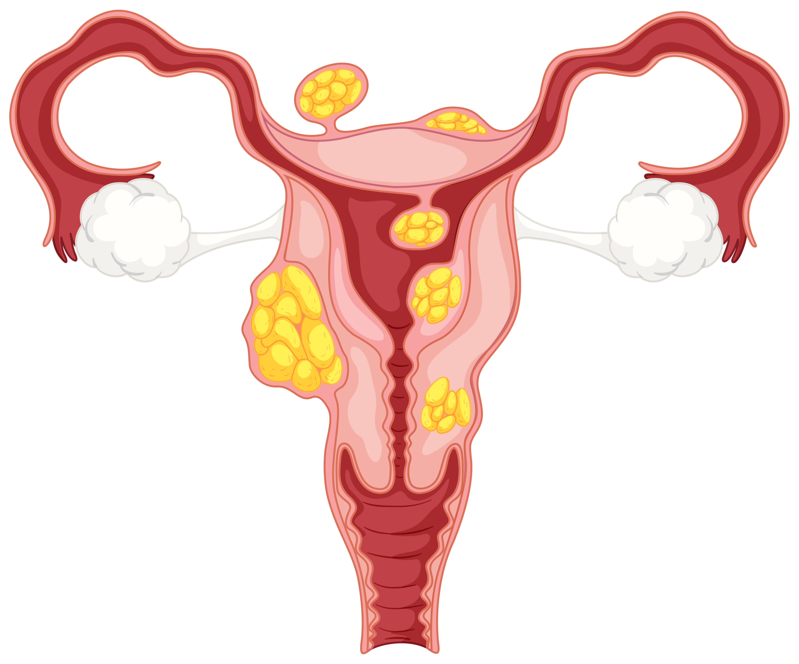  Fibromi uterini: patologia frequente: ma cosa sono?