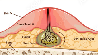 Cura e trattamento per le cisti sacrococcigea