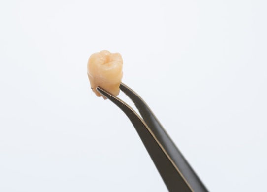 Denti del giudizio inclusi o mal posizionati