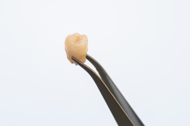 Denti del giudizio inclusi o mal posizionati