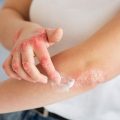 Eczema sintomi, cause e terapie