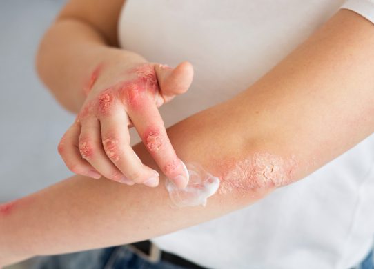 Eczema sintomi, cause e terapie