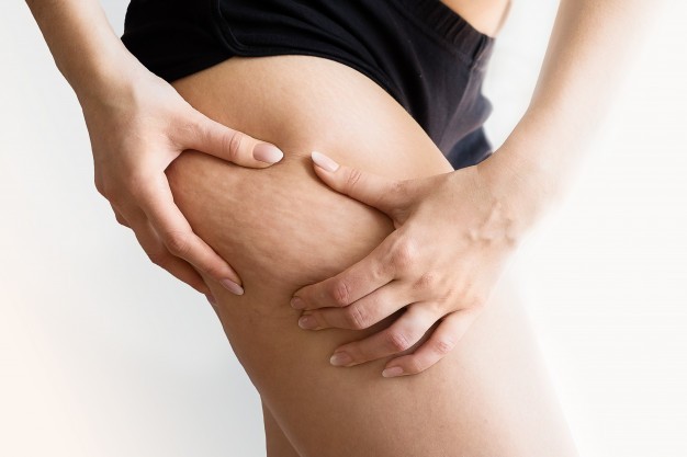 Eliminare la cellulite con la medicina estetica