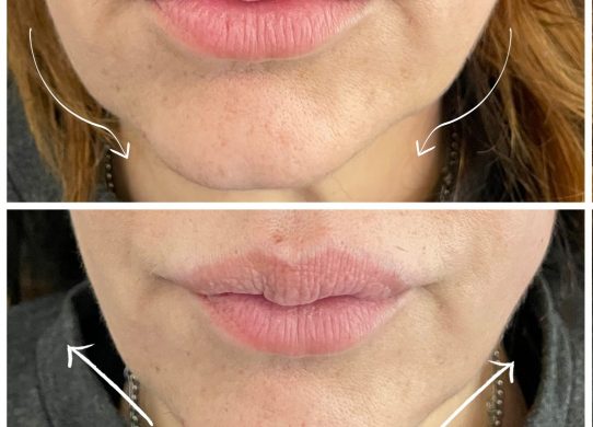 Fili di trazione l’alternativa non chirurgica al lifting