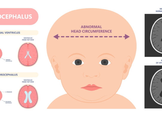 Idrocefalo cos’è e come curarlo