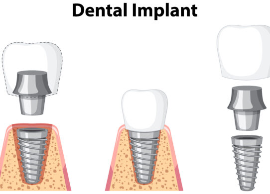 L'Impianto Dentale Singolo: Una Soluzione Avanzata per il Ripristino del Dente Mancante