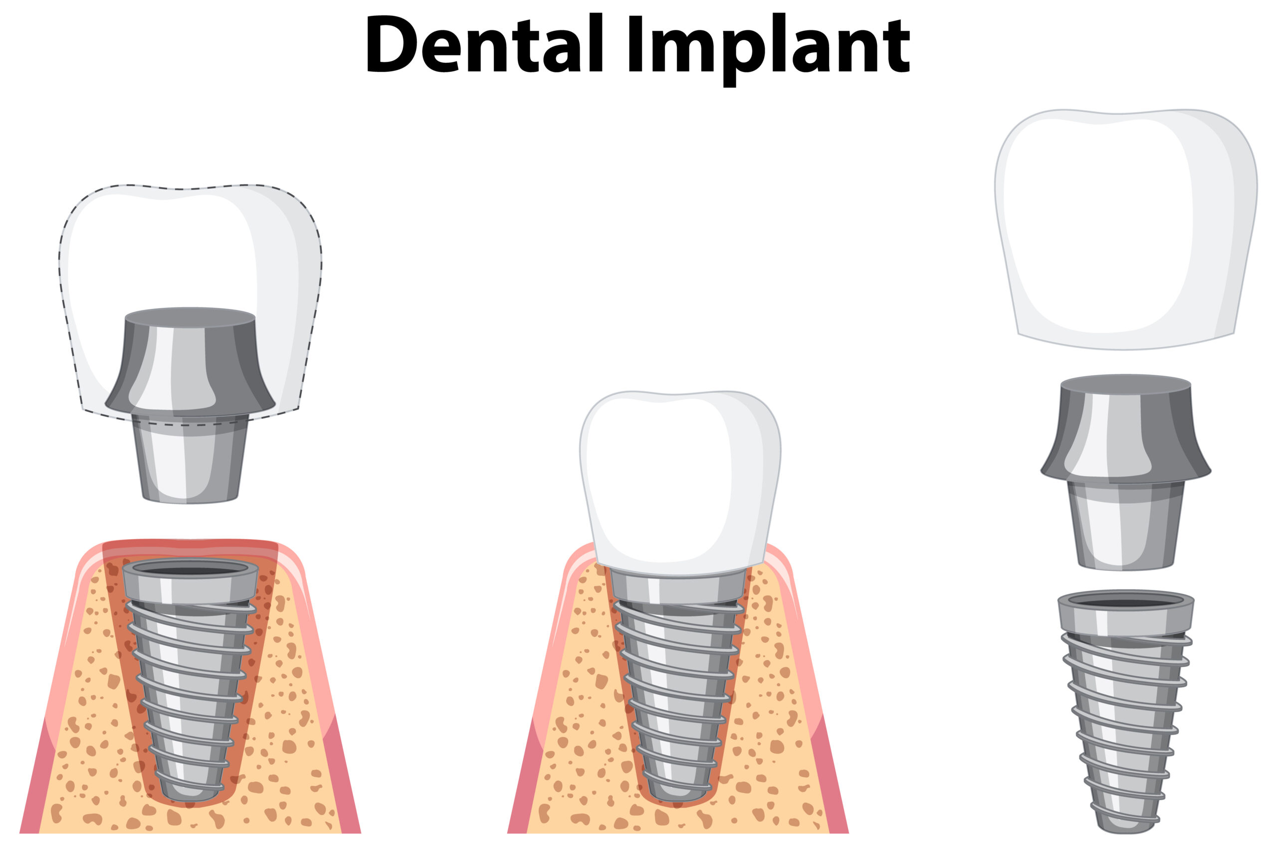 L’Impianto Dentale Singolo: Una Soluzione Avanzata per il Ripristino del Dente Mancante