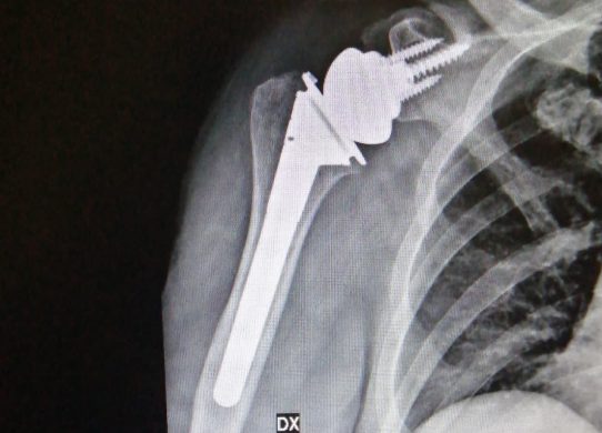 La patologia artrosica della spalla ed il trattamento chirurgico di protesi inversa