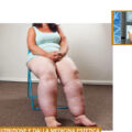 Lipedema un aiuto dalla nutrizione e dalla medicina estetica
