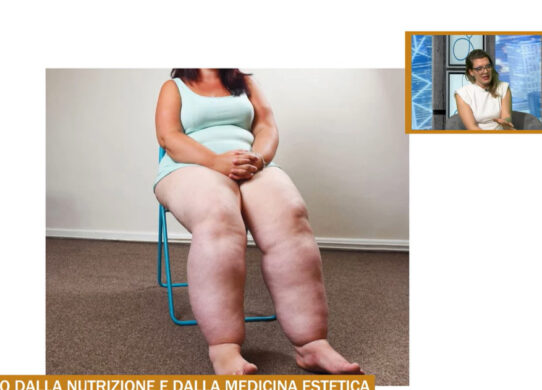 Lipedema un aiuto dalla nutrizione e dalla medicina estetica