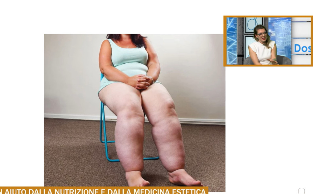 Lipedema un aiuto dalla nutrizione e dalla medicina estetica