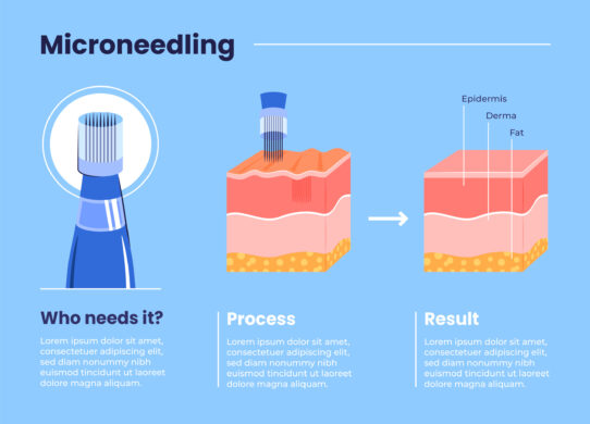Microneedling efficacia e funzionalità della tecnica che ringiovanisce il viso