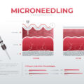 Microneedling non solo ringiovanimento del viso