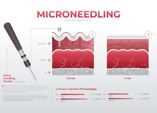 Microneedling non solo ringiovanimento del viso