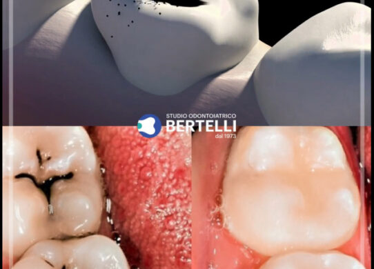 Otturazione dentale Riparazione efficace per la salute dei denti