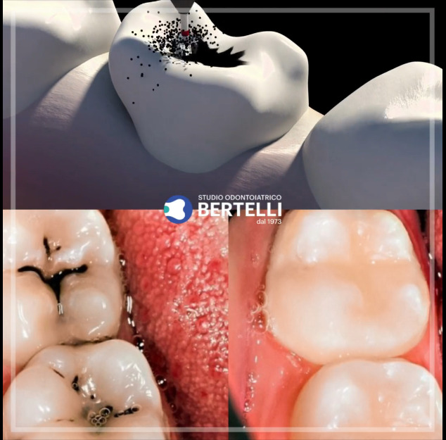 Otturazione dentale Riparazione efficace per la salute dei denti